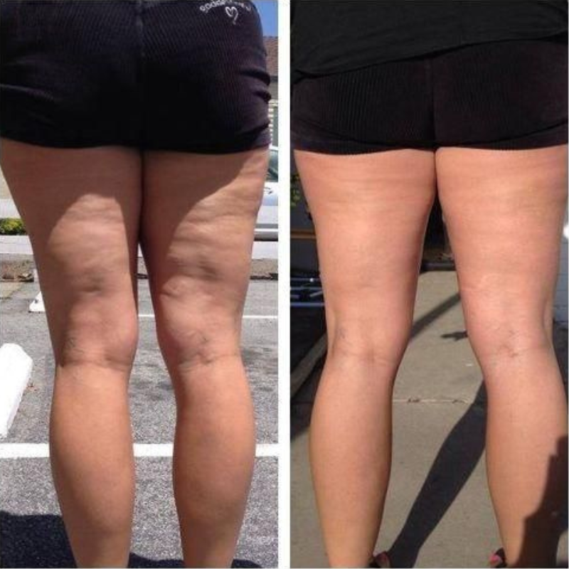 The Only Oil That Smooths Away Cellulite While You Sleep