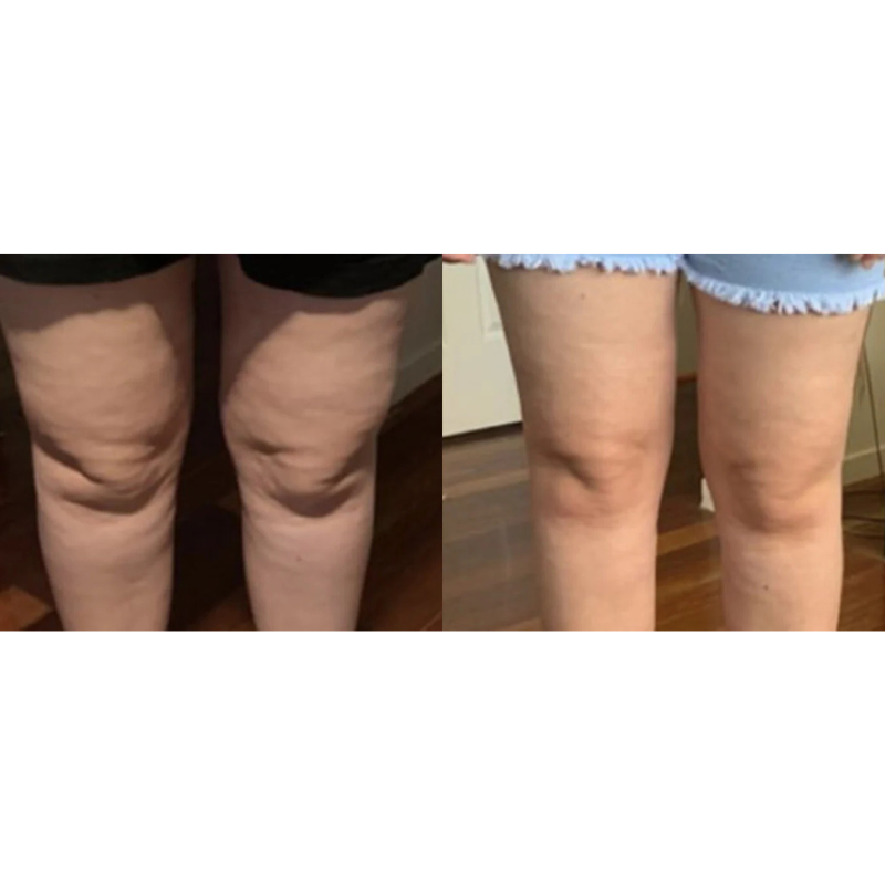 The Only Oil That Smooths Away Cellulite While You Sleep